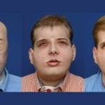 Firefighter Burn Injury Transplant