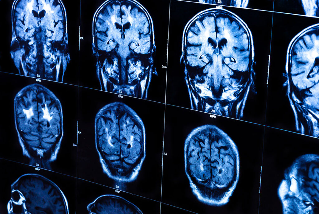 MRI scan images showing multiple views of a human brain with visible areas of neocortical damage, used in research on traumatic brain injury in veterans and first responders.